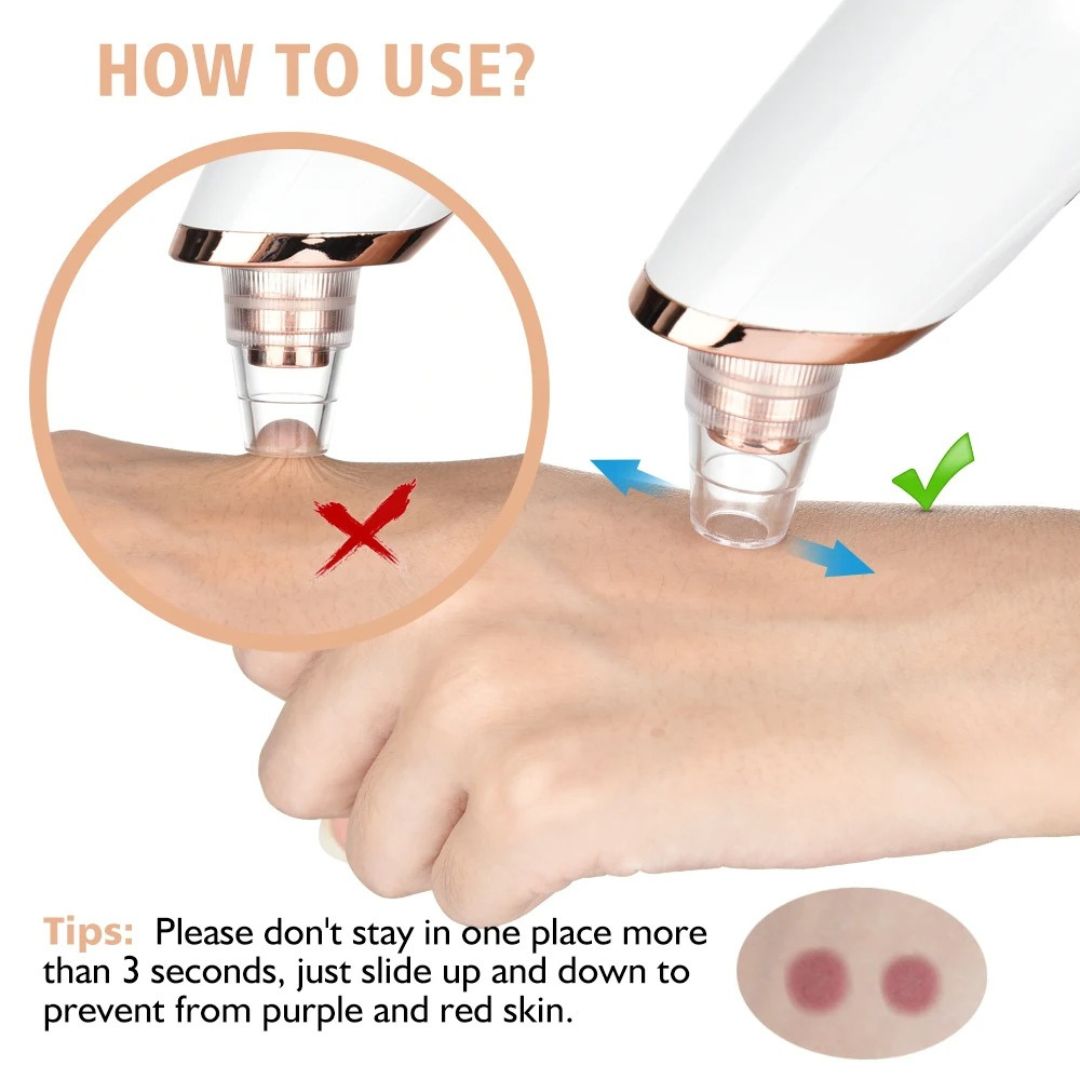 Elurelia™ PoreSonic Blackhead Remover