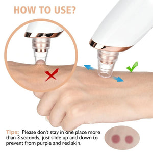 Elurelia™ PoreSonic Blackhead Remover